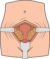 개복수술
