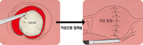 자궁근종 절제술