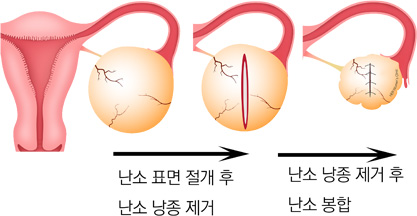 자궁근종 절제술